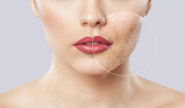 Acne scar treatment options