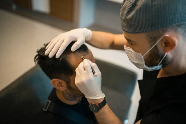 Myths and Facts about Hair Transplant