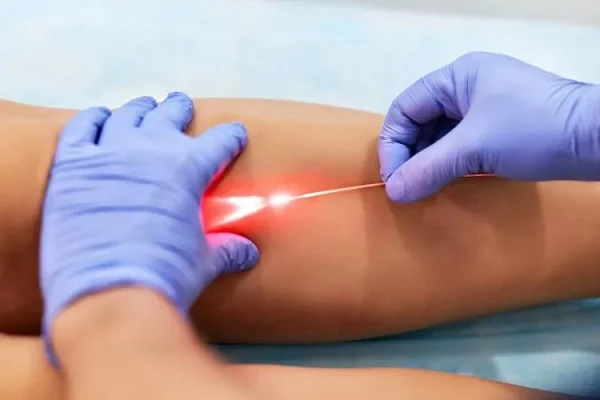 1710931438Tips to Care after Varicose Veins Laser Treatment